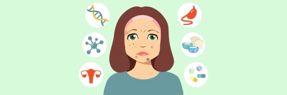 Vznik akné může mít skutečně mnoho příčin, od hormonální nerovnováhy, přes zánět pokožky až k závažnějším onemocněním často spojeným s imunitou